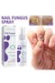 Fungus Spray Toenail Fungus Treatment Nail Fungus Toenail Treatment - 2