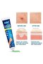 Urticaria Cream Ointment for Allergic Reactions, Skin Rash Relief, Redness Reduction, Care - 2
