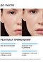 18% Anti-Acne Smart Peeling System 30 ml - 4