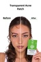 Transparent Acne, Pimple Patch 36 Pieces - 4
