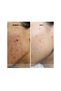 Tretinoin 0.05% Anti-Acne Retinoid Cream 30g - 3