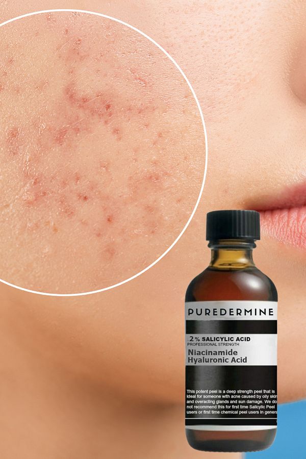 Puredermine-Salicylic Acid & Dull Clogged Pores & Blackhead & Acne Serum & Niacinamide + Ha 1