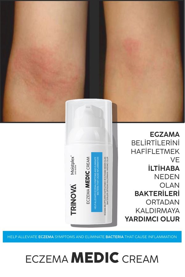 Trinova-Eczema Cream 1