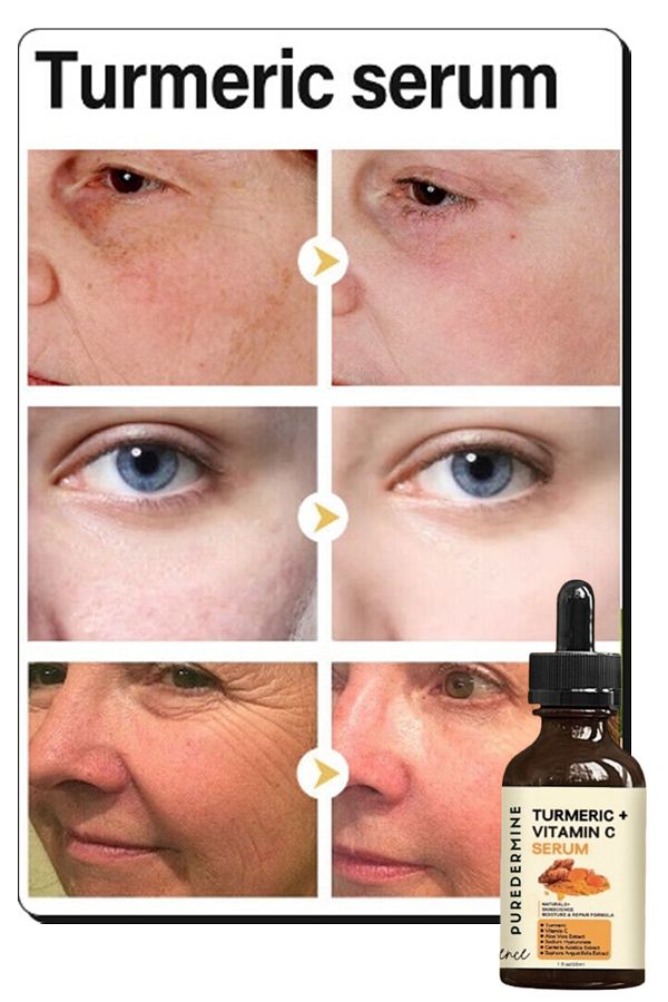 Puredermine-Strong Whitening Turmeric Serum Dark Spot & Acne & Melasma & Dark Joint & Finger Knee and Elbow 1