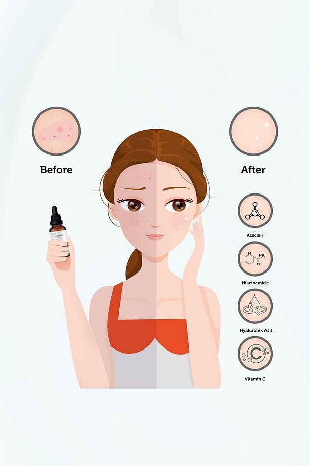 Ton Eşitleme, Gözenek Siyah Nokta Ve Sivilce Oluşumunu Gidermeye Yardımcı Süper Serum - 6