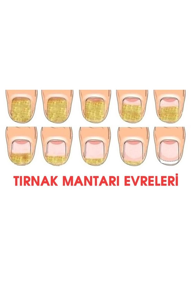 Tırnak Mantarı Önleyici Ve Ayak Kremi - 8
