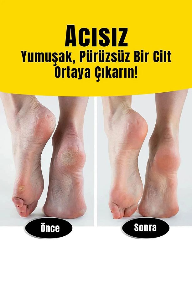 Topuk Nasır Temizleme Bakımı Ayak Bakım Törpüsü Kutulu Ayak Rendesi - 5