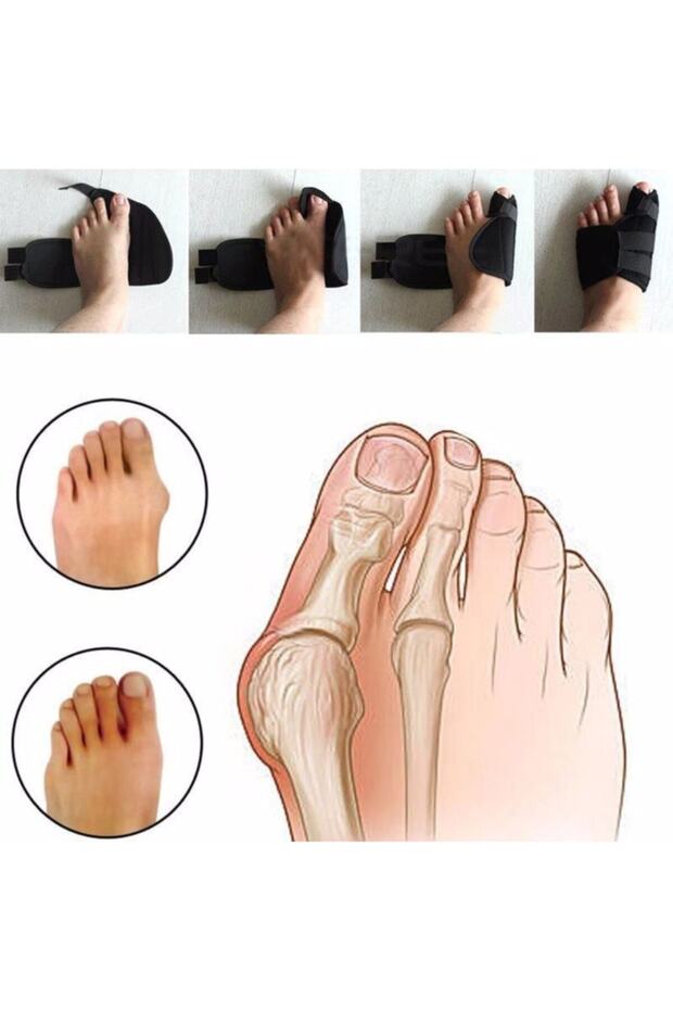 Medikal Halluks Valgus Gece Ateli Ayak Baş Parmak Bunyon Koruyucu 1 Çift (SAĞ VE SOL) - 3