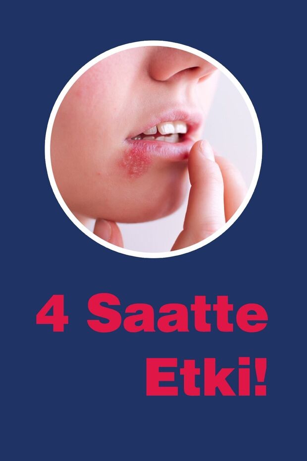 Ux Uçuk Kremi 7 ml 3 ml ( Çay Ağacı Yağı / Tea Tree Oil ) - 3