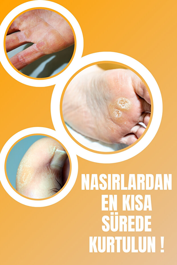 مجموعة مزدوجة لعلاج مسامير القدم - مزيل ومحلول - 3