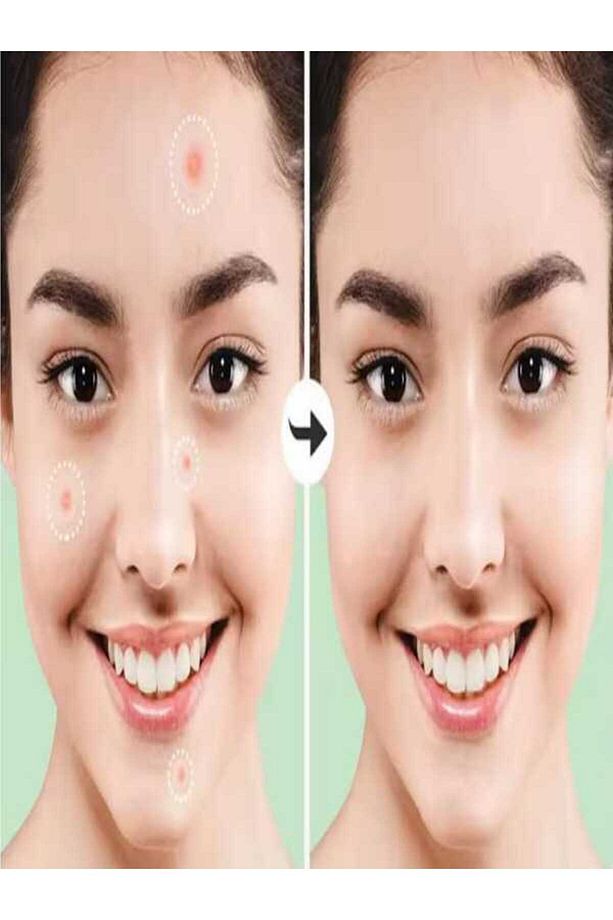 Akne Sivilce Bandı 48 Adet Hidrokolloid, Original Pimple Patch Hydrocollaid - 1