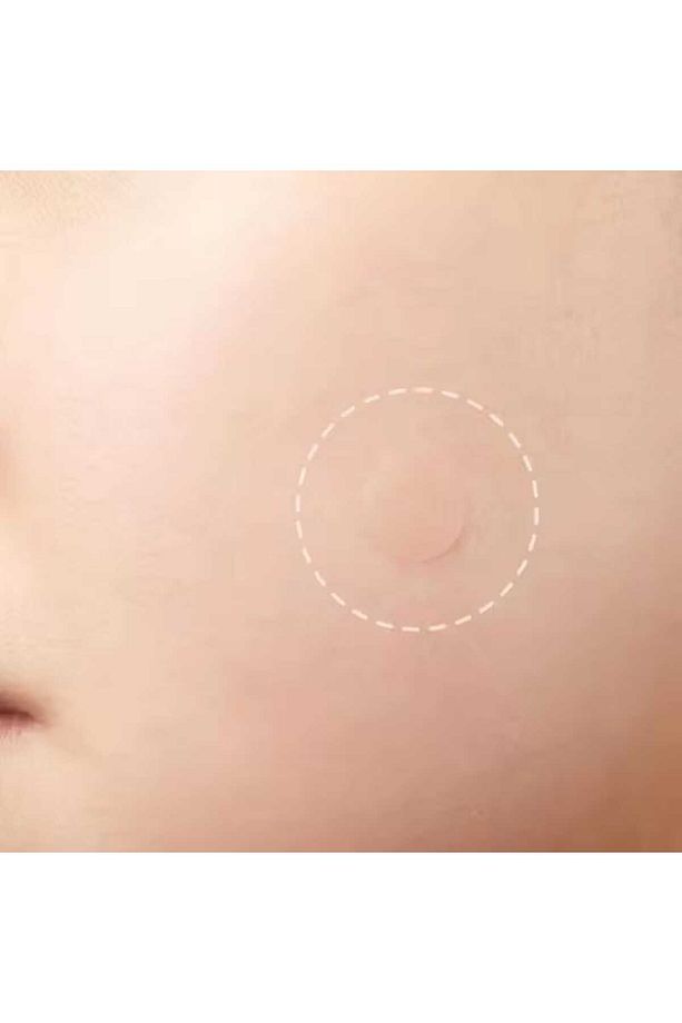 Akne Sivilce Bandı 48 Adet Hidrokolloid, Original Pimple Patch Hydrocollaid - 2