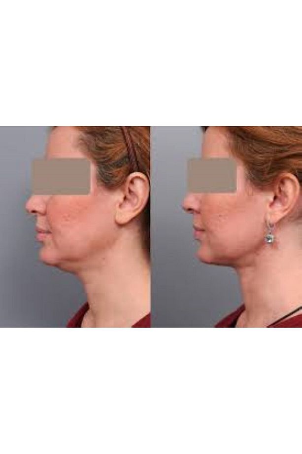 Lipo Mezoterapi Gıdı Eritme, Yanak Inceltme [1 Flakon 5ml Fiyatıdır] - 2