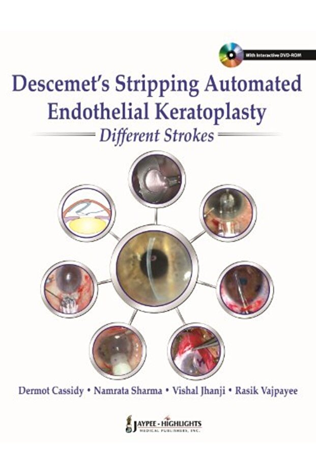 Descemets Stripping Automated Endothelial Keratoplasty Different Strokes