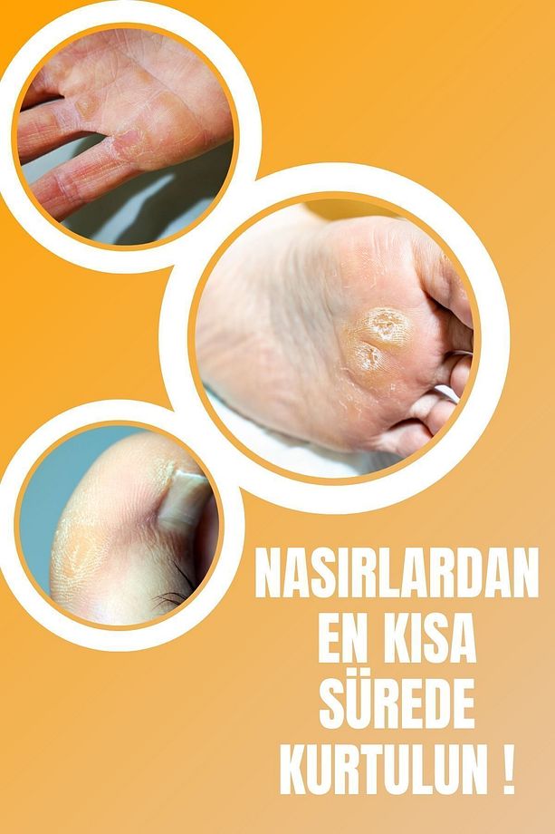 Nasır Tedavi Seti, Nasır Sökücü, Nasır Solüsyonu, Nasır Tedavi Seti, Nasır Giderici - 7
