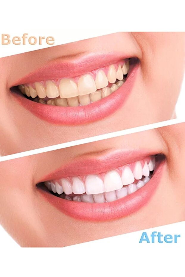 Diş Beyazlatma Seti - 6