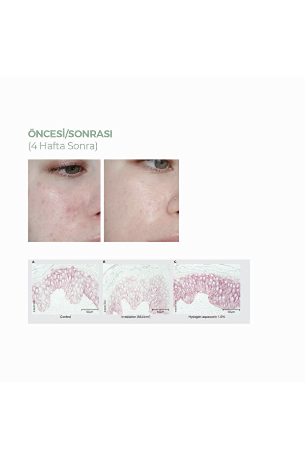 Anti-Acne Serum 30ML - 8