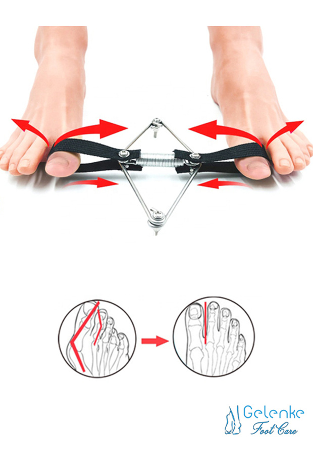 Metal Exercise Band and Bunion Apparatus - Hallux Valgus Thumb Bone Corrector