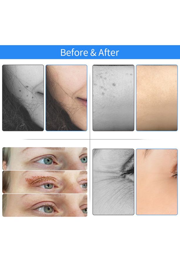 Plexr Plasma Pen Çatlak Ben Siğil Leke Dövme Için En Uygun Ürün - 8