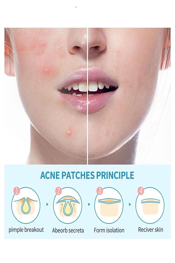 2'li Akne Ve Sivilce Bandı Pimple Patch 72 Patch - 3