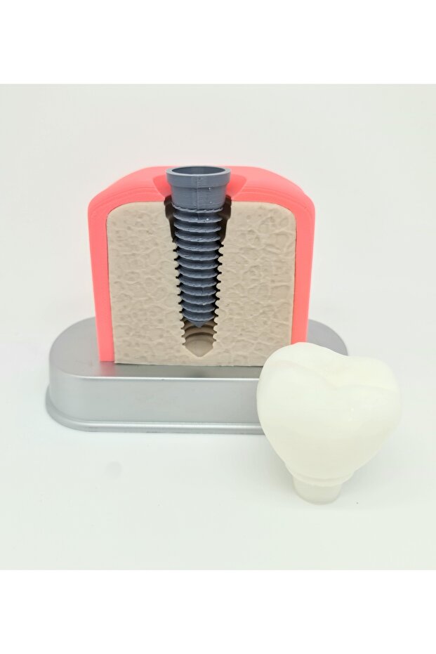 İmplant Modeli - 3