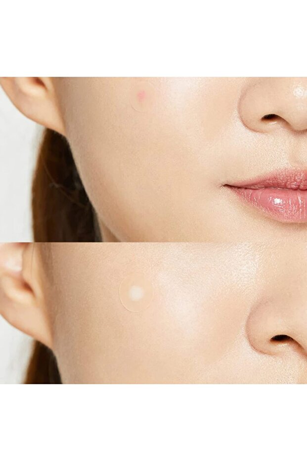 رقعة علاج حب الشباب والبثور - 24 رقعة - 5