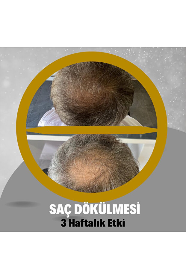 PROCAPİL PLUS %10 - 5