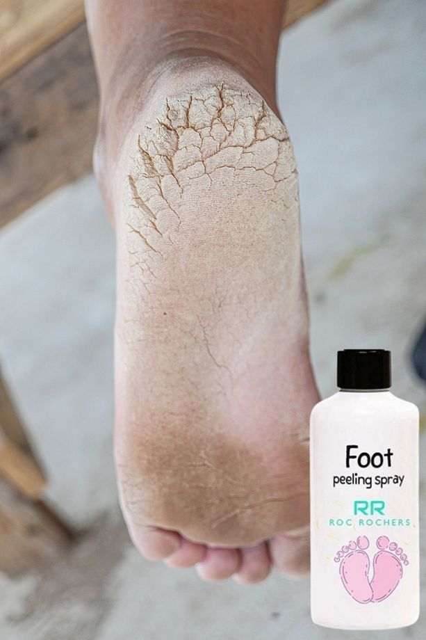 Ayak Peeling & Topuk Çatlak Giderici & Ayak - Topuk Soyma & Topuk Peeling & Ayak Soyma Sprey - 2