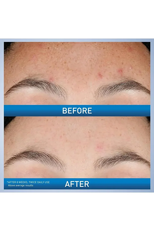 CeraVe Resurfacing Retinol Serum to Reduce Post-Acne Marks and Pores with Retinol, Licorice Root Ext - 5