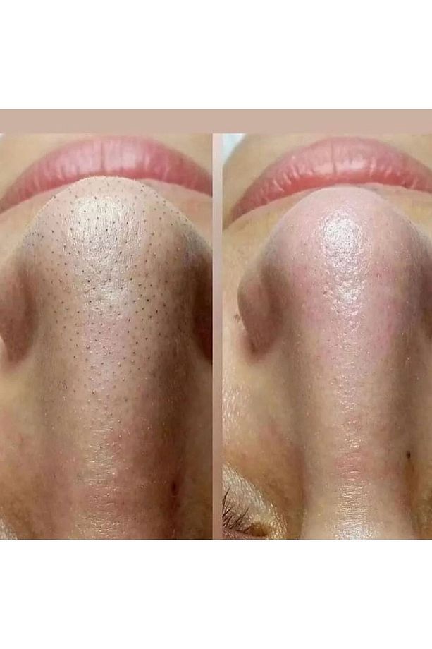 PEELİNG JEL (soyucu krem) + Egş DERMA delete ATKUYRUKLU ŞAMPUAN - 2