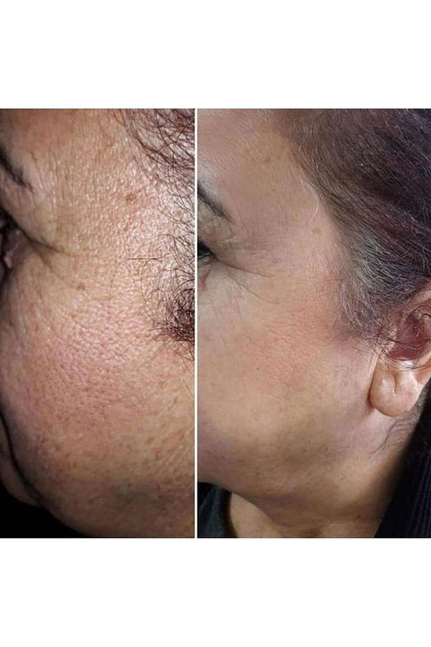 PEELİNG JEL (soyucu krem) + Egş DERMA delete ATKUYRUKLU ŞAMPUAN - 3