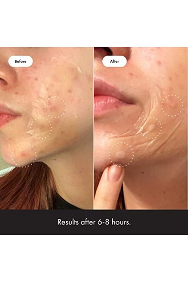 السطح - رقعة هيدروكولويد لعلاج حب الشباب الكبير (10 قطع) - 6