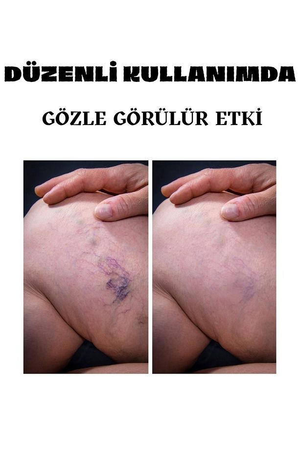 Varicose Veins Var.is Kremi 100 ML - 3