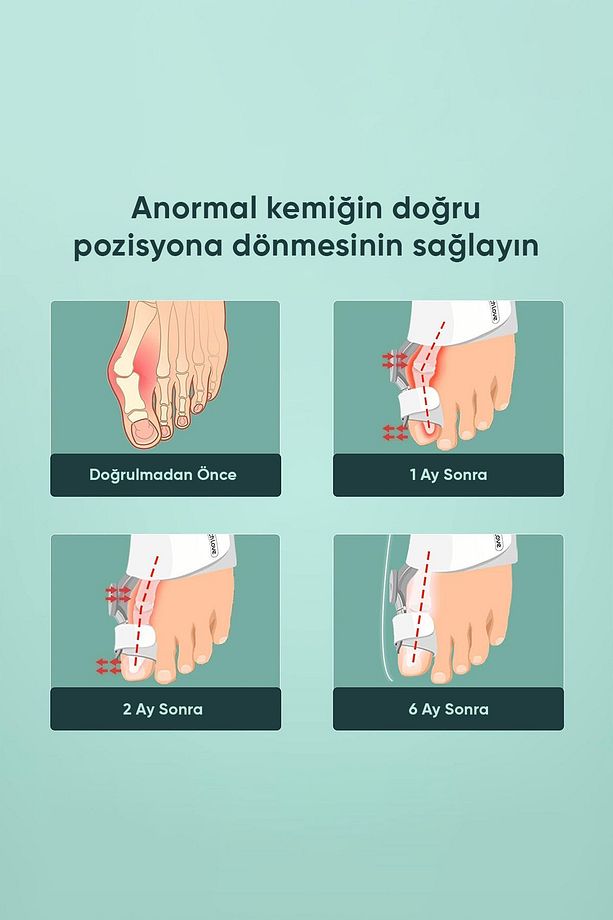 Ayak Baş Parmak Kemik Düzeltici Ayak Parmağı Halluks Valgus Ateli Bunyon Eğrilik Aparat - 3