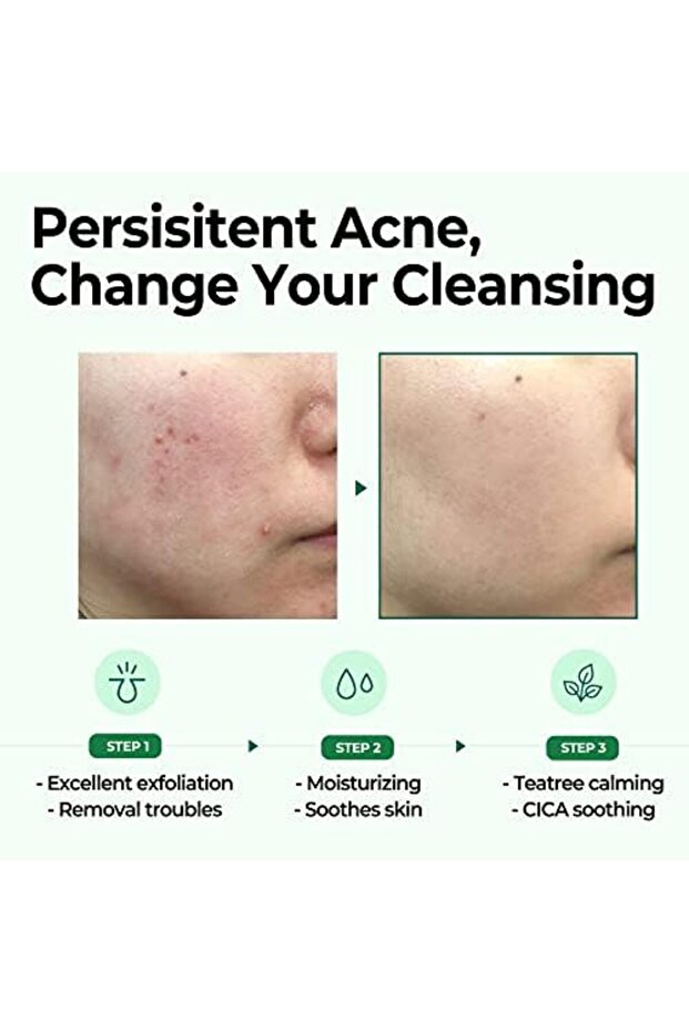 Miracle Bar Soap for Skin Cleansing in 30 Days with AHA, BHA, and PHA from Some By Mi - 6