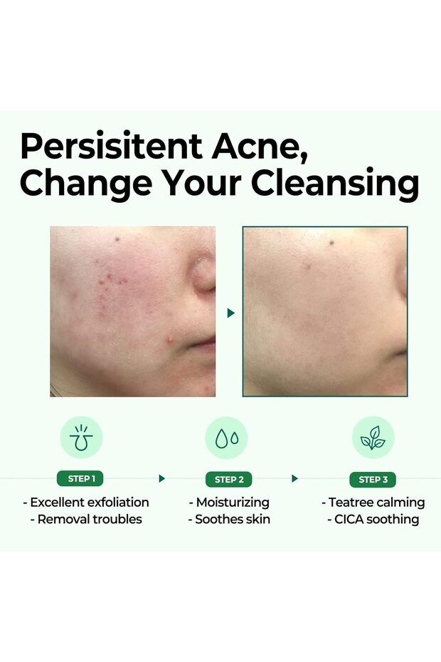 Miracle Bar Soap for Skin Cleansing in 30 Days with AHA, BHA, and PHA from Some By Mi - 5