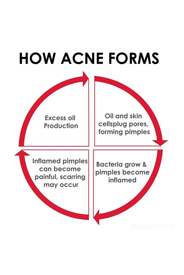 Sebionex Purifying Bar 100g –soap-free Daily Cleanser For Oily & Acne-prone Skin, Gentle & Effective - 3