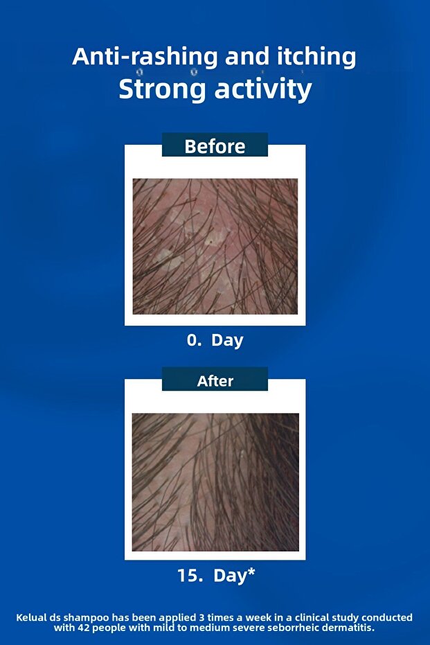 Kelual DS 100 ml Stubborn and Violent Anti-Dandruff Shampoo - 4