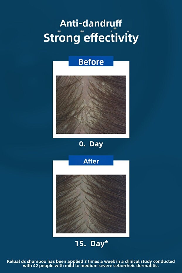Kelual DS 100 ml Stubborn and Violent Anti-Dandruff Shampoo - 3