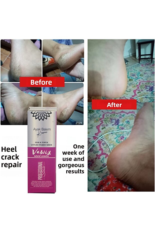 Foot Care Cream for Heel Spurs and Cracked Heels - 100 ml.