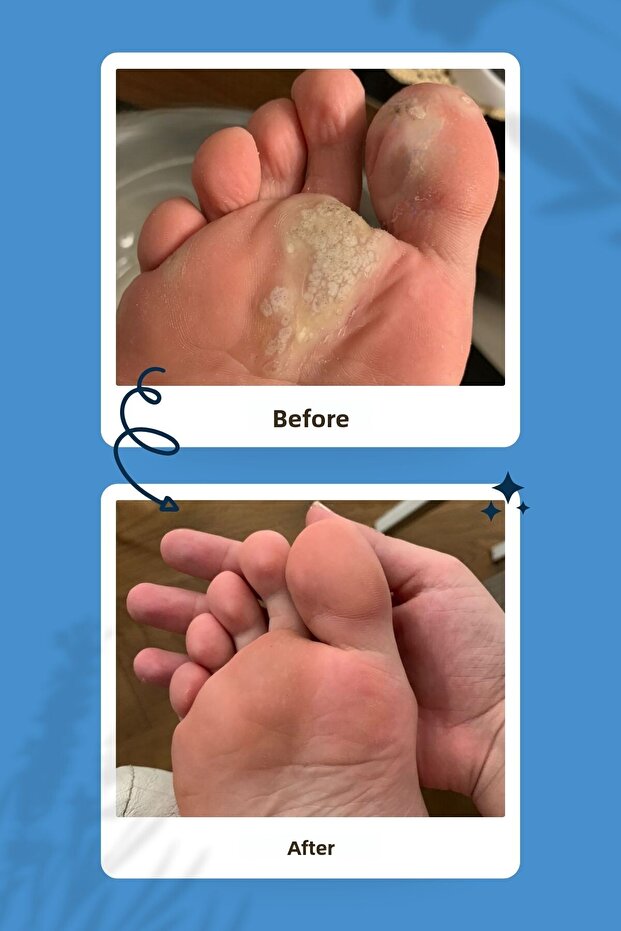Callus Remover Solution - 2