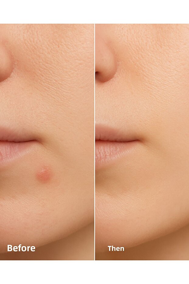 Clearly Spot Patch 24 Pack Band I Hydrocolloid, Niacinamide Content Anti-Acne / Band - 4