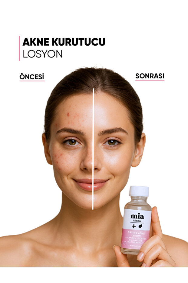 Akne Karşıtı Sivilce Kurutucu Losyon - 6