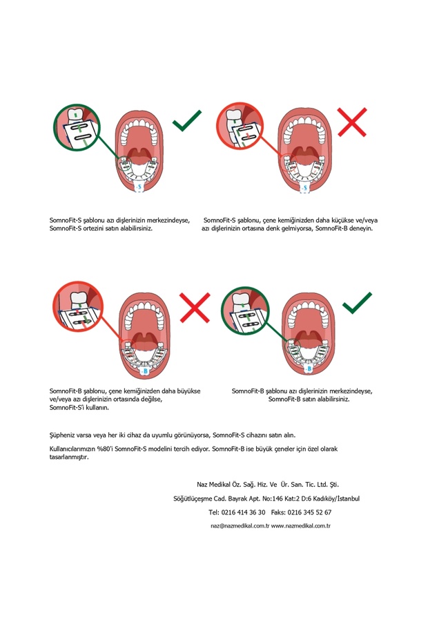 SomnoFit-B, Mandibular (Alt Çene) İlerletme Aparatı - 8