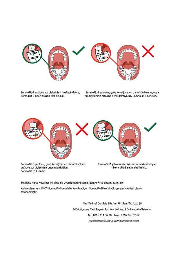 SomnoFit-S, Mandibular (Alt Çene) İlerletme Aparatı - 5