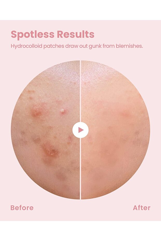 Invisible acne patch - 5