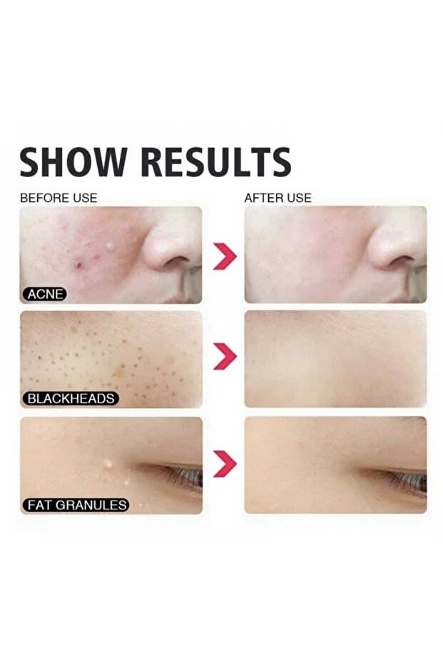 Blackhead remover tool - 6