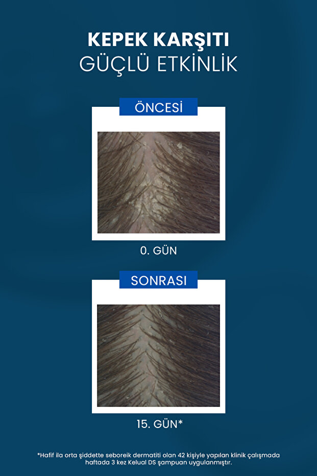 İnatçı & Şiddetli Kepek Karşıtı Şampuan Seti 2'Li Set - 4