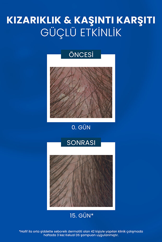 İnatçı & Şiddetli Kepek Karşıtı Şampuan Seti 2'Li Set - 5
