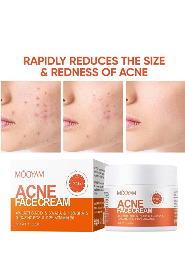 MOOYAM Acne Treatment for Face for Hormonal Cystic Stubborn Acne Cream for Sensitive Skin Teens Adul
